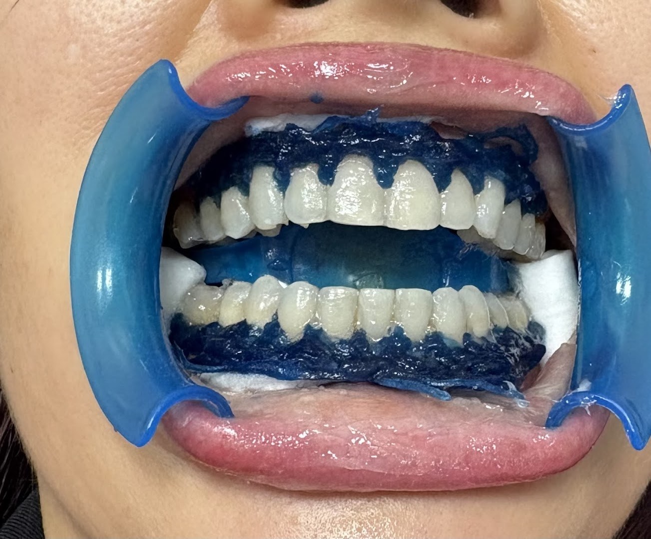 Teeth during whitening with protective gum barrier